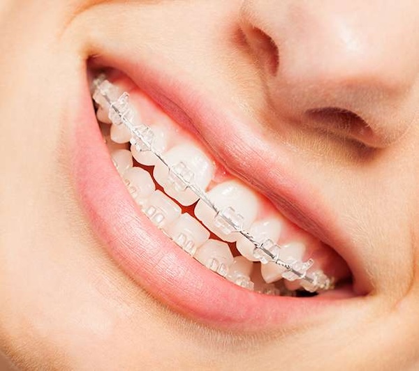Clear Braces in Manalapan, NJ