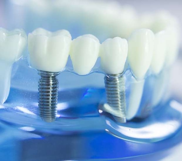 Dental Implants in Manalapan, NJ