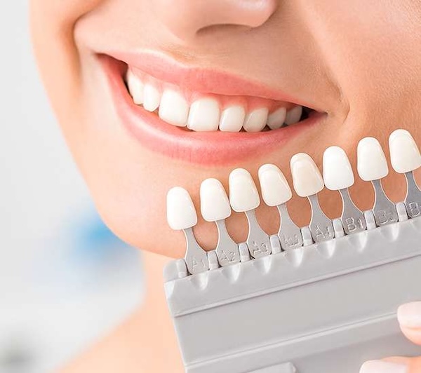 Dental Veneers in Manalapan, NJ