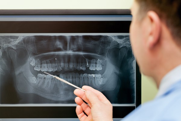 Reasons For Bone Grafting Before Dental Implants