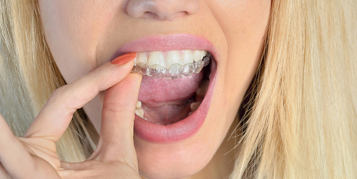 Invisalign  Route 9 Dental